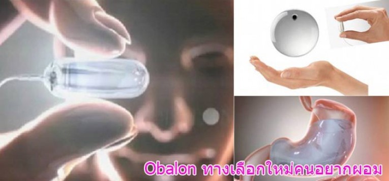 obalon บอลลูน ในกระเพาะอาหาร ลดความอ้วน ลดน้ำหนัก