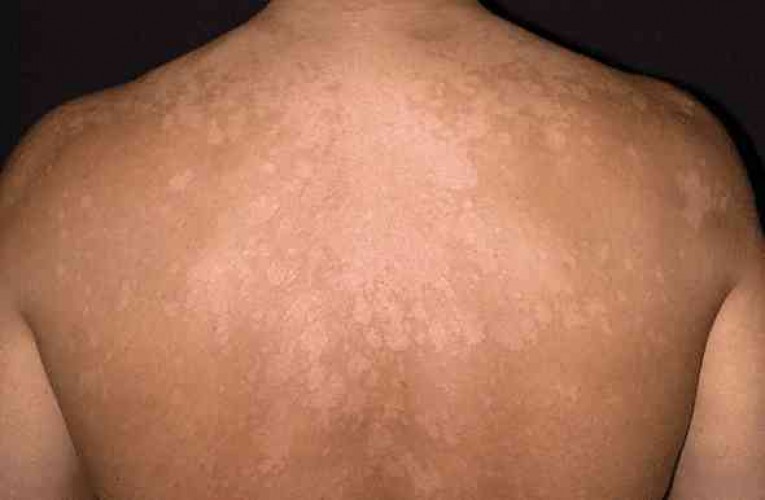 tinea-versicolor เกลื้อน เชื้อรา อาการ