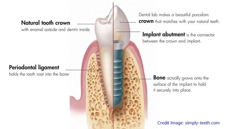 Dental-Implants ฟันปลอมแบบรากฟันเทียม