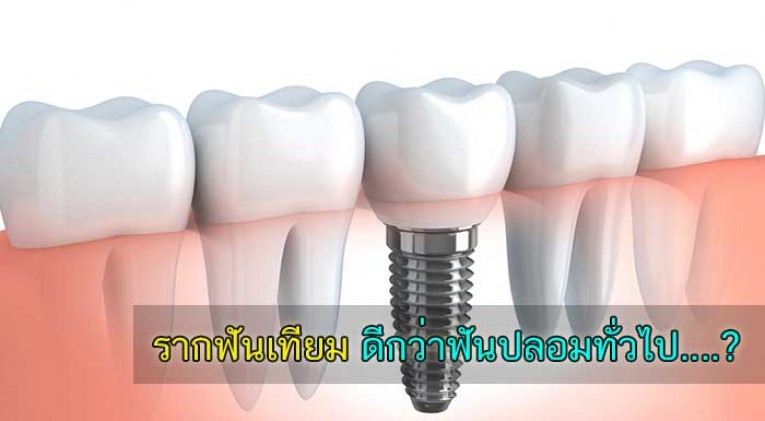 implant รากฟันเทียม ราคา ที่ไหนดี