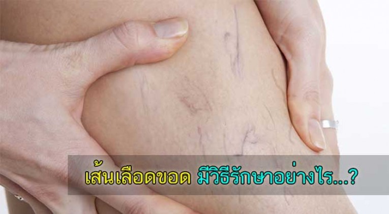 varicose vein เส้นเลือดขอด ปูดพอง มีวิธีรักษาอย่างไร