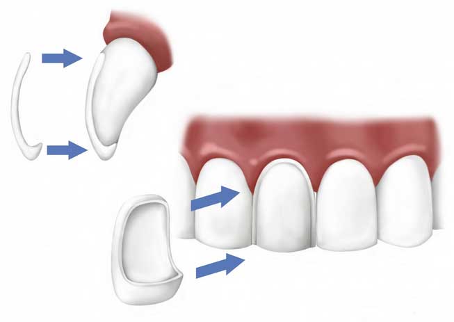 ฟันแตก ฟันห่าง ฟันเหลือง แก้ปัญหาง่ายๆด้วยการทำวีเนียร์ Veneer