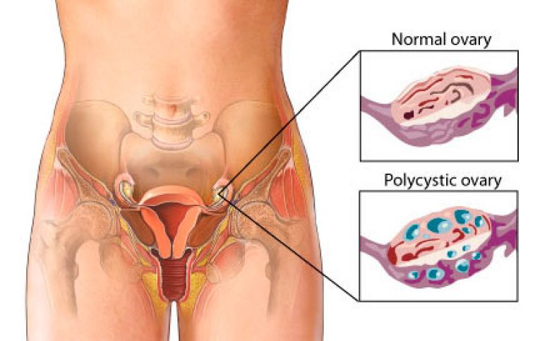 โรค pcos กับการตั้งครรภ์