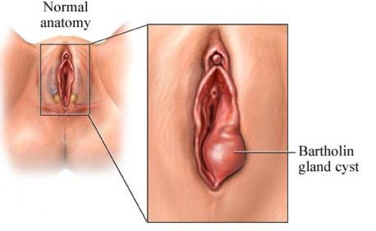 ต่อมบาร์โธลิน โต อักเสบ บวม สาเหตุ วิธีการรักษา Bartholin gland