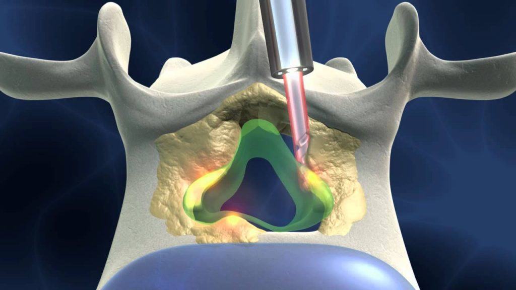 spinal stenosis การพยาบาล