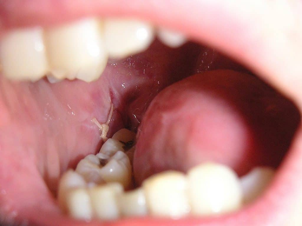 bitter-taste-in-mouth-causes-treatment-home-remedies-bitter-taste