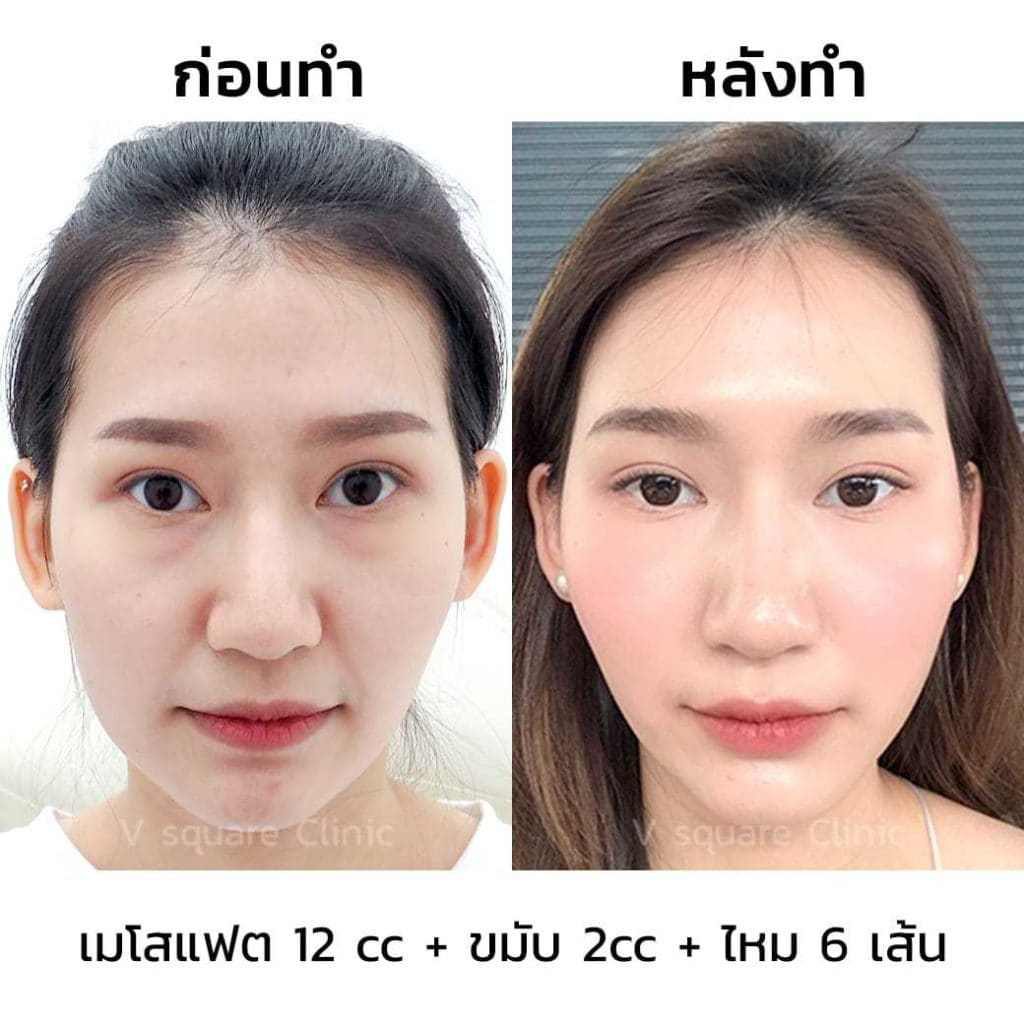 ตัวอย่างรีวิว-ฉีดฟิลเลอร์ขมับ-2-cc