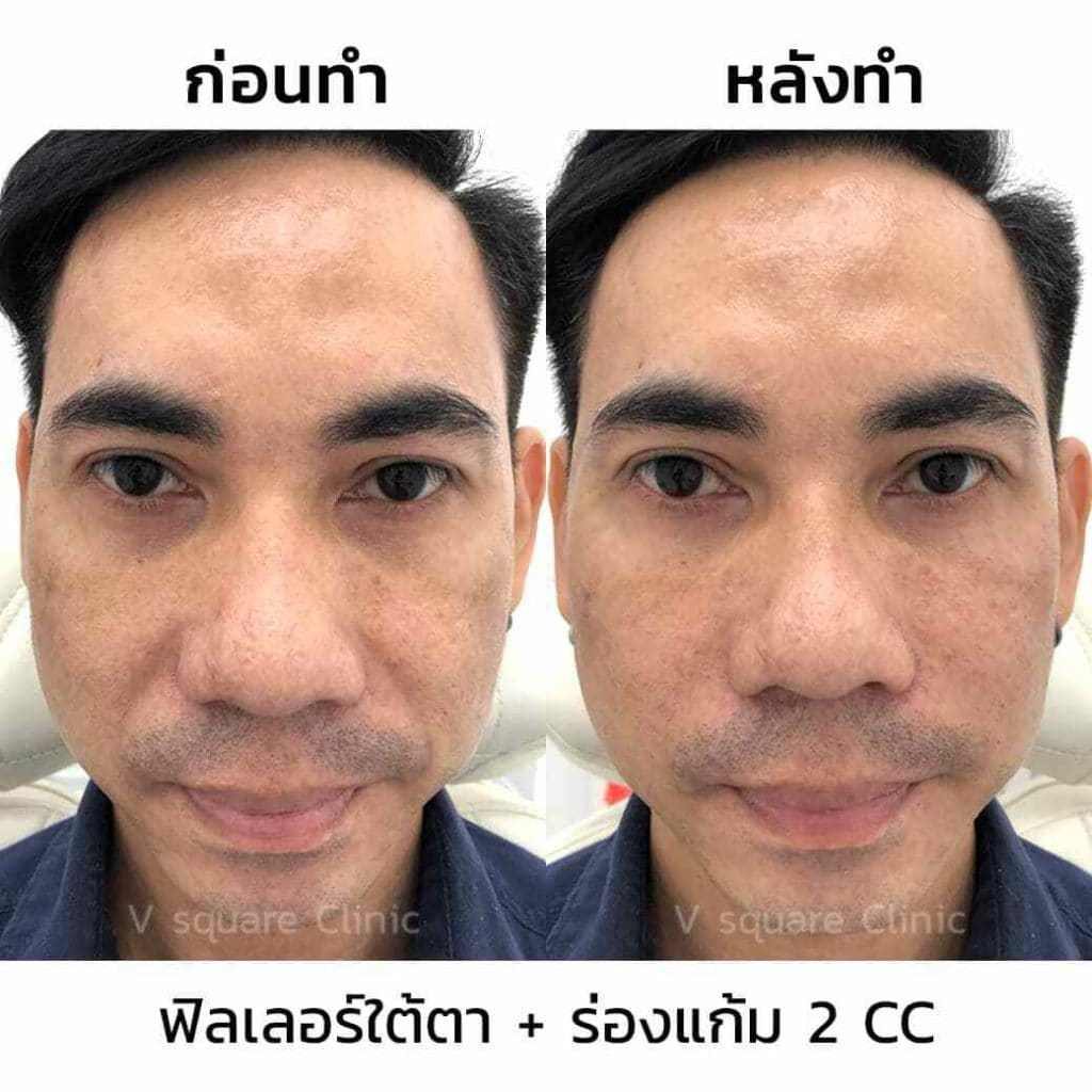 รีวิวฉีดฟิลเลอร์ร่องแก้ม