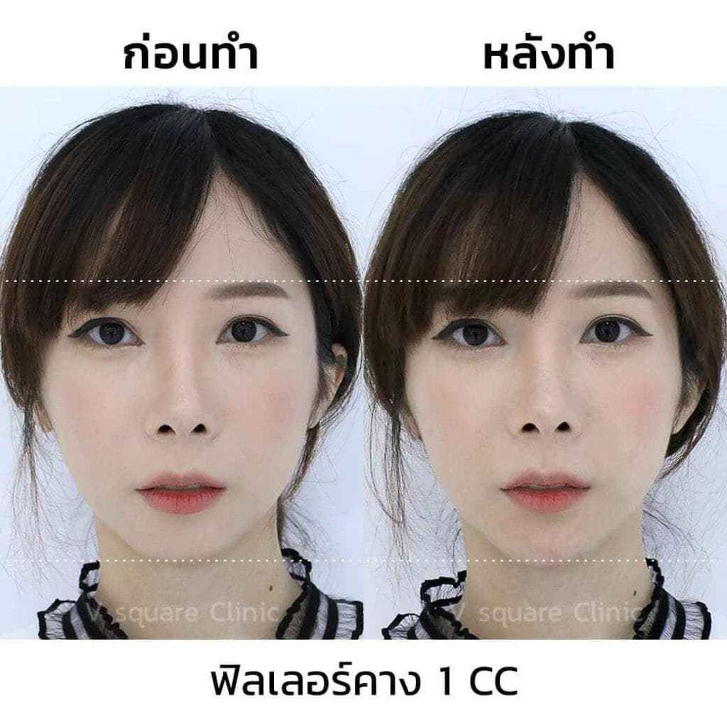 รีวิวฟิลเลอร์คาง-1CC