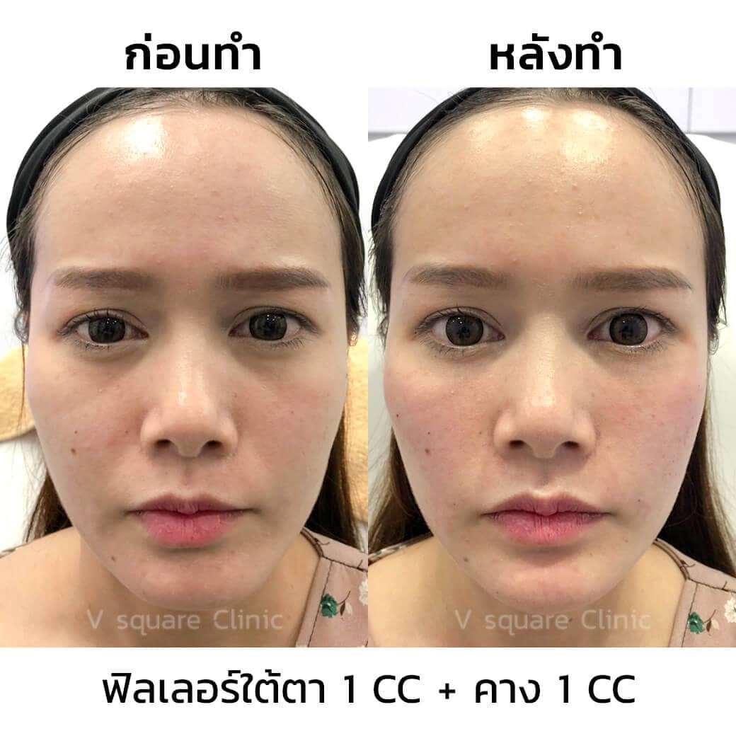 รีวิว-ฉีดฟิลเลอร์คาง