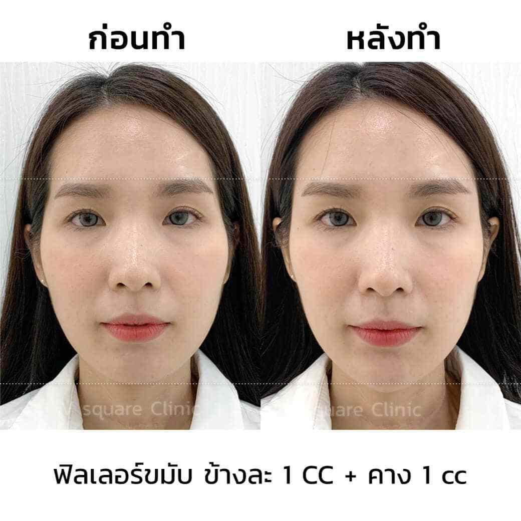 รีวิว-ฟิลเลอร์ขมับข้างละ1cc-คาง1cc