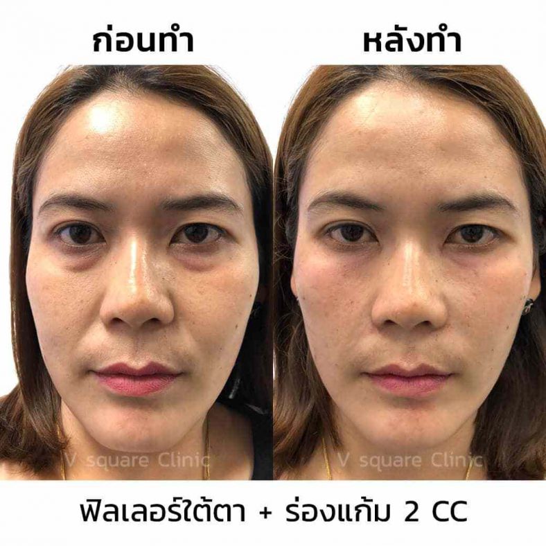 รีวิวฟิลเลอร์ร่องแก้มใต้ตา2cc