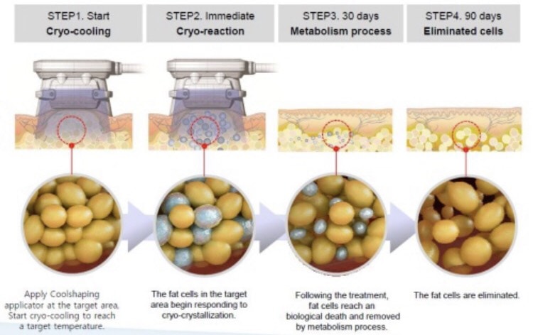 การทำงานของเครื่อง-coolsculpting-สลายไขมันด้วยความเย็น