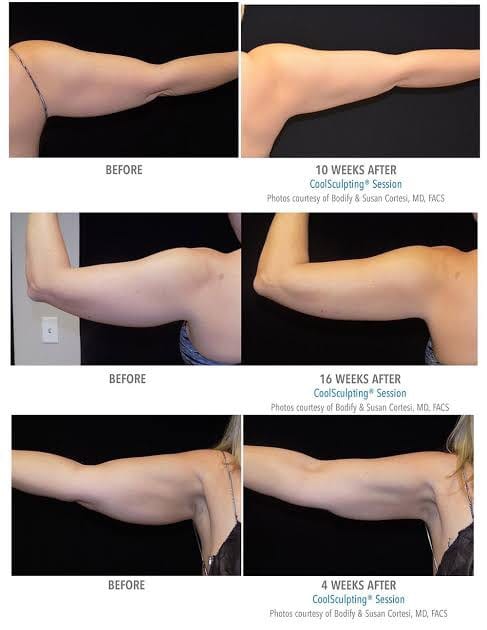 ผลการรักษาด้วยเครื่อง CoolSculpting สลายไขมันด้วยความเย็น ที่ต้นแขน