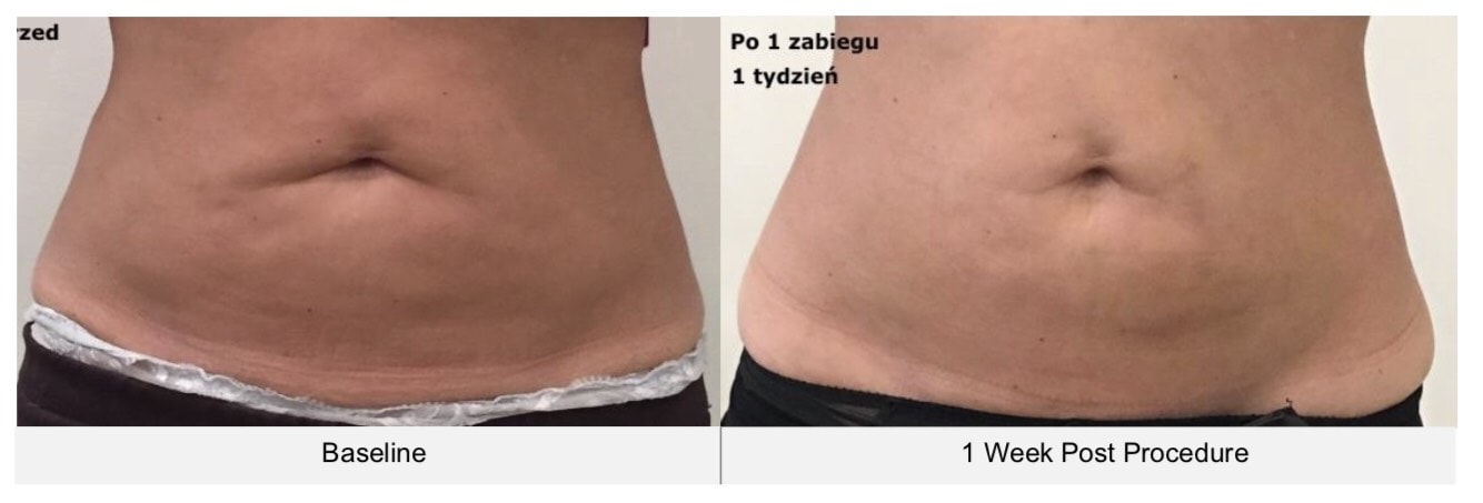 รีวิวผลการรักษา-cellulite-บริเวณหน้าท้องด้วยเครื่อง-ultraformer-iii