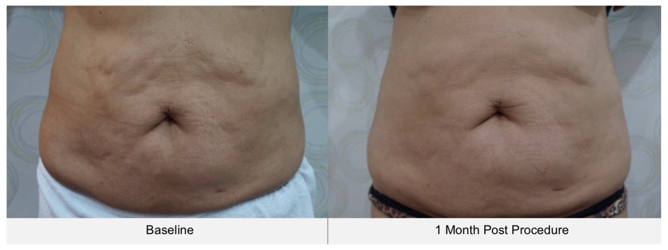 ตัวอย่างรีวิวผลการรักษา-cellulite-บริเวณหน้าท้องด้วยเครื่อง-ultraformer-iii