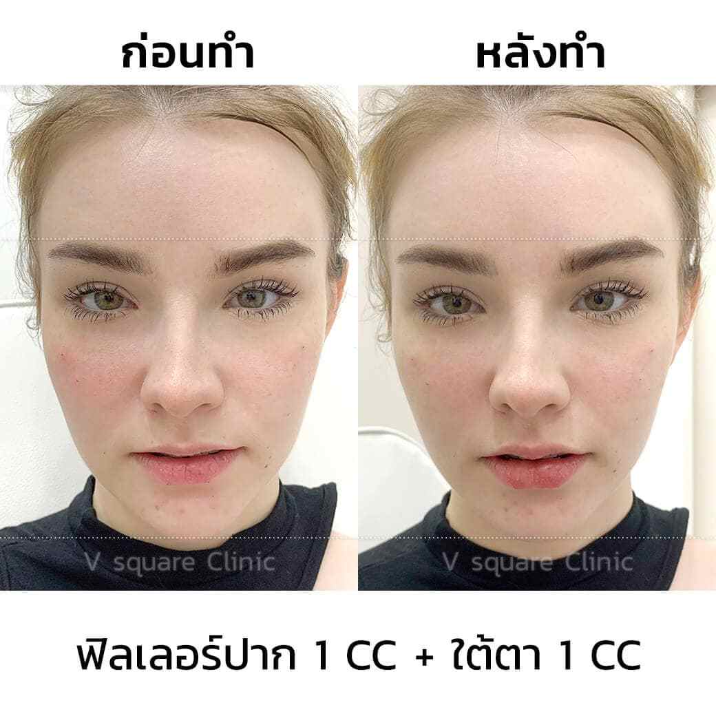 รีวิวฉีดฟิลเลอร์ปาก-1cc-ใต้ตา1cc