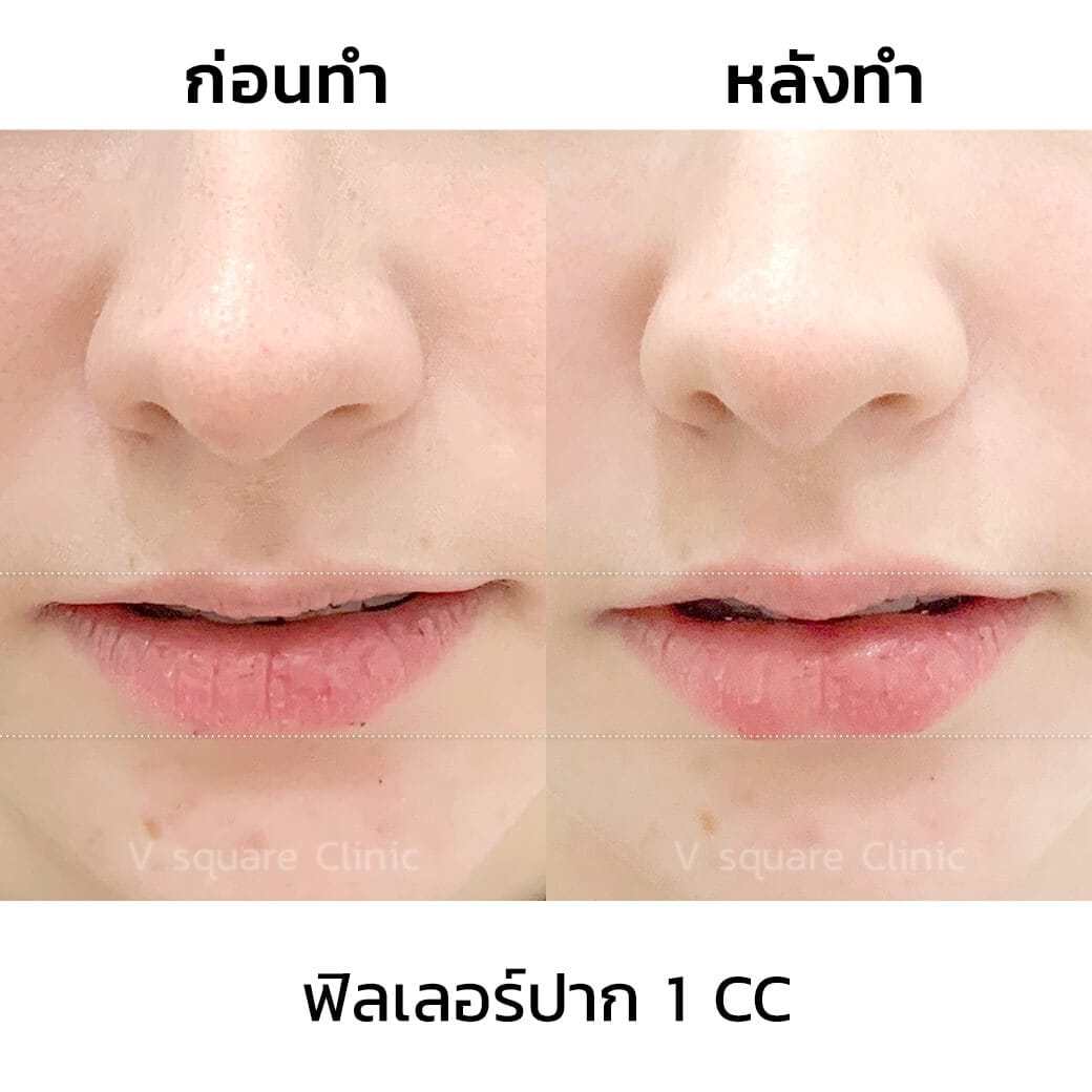 รีวิวฉีดฟิลเลอร์ปาก-1cc ราคา