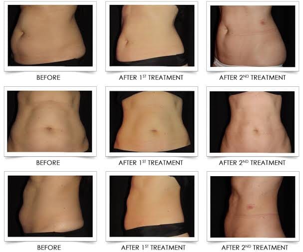 ผลการรักษาด้วยเครื่อง CoolSculpting สลายไขมันด้วยความเย็น ที่หน้าท้อง