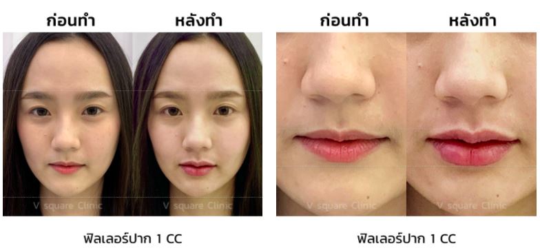 รีวิว-ฉีดฟิลเลอร์ปาก-1cc-ก่อนทำหลังทำ