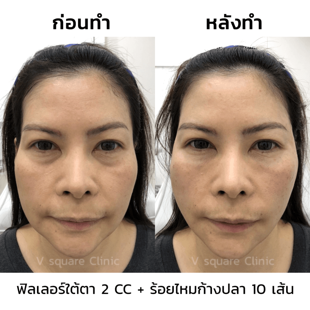 รีวิว-ร้อยไหมก้างปลา-10-เส้น-ฟิลเลอร์ใต้ตา