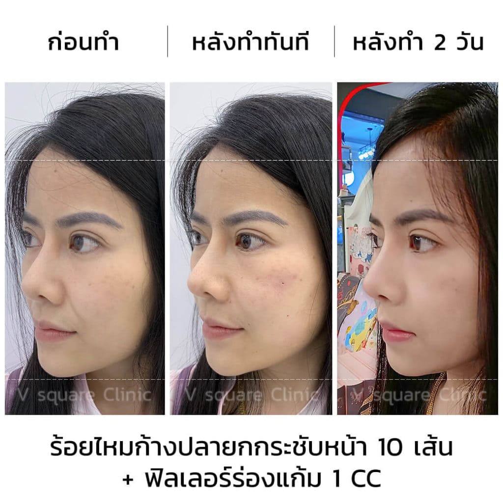 ร้อยไหม10เส้นและเติมฟิลเลอร์ร่องแก้ม1cc_ด้านข้าง