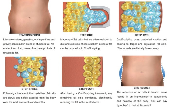 การทำงานของเครื่อง CoolSculpting ที่ช่วยลดไขมันที่พุงได้