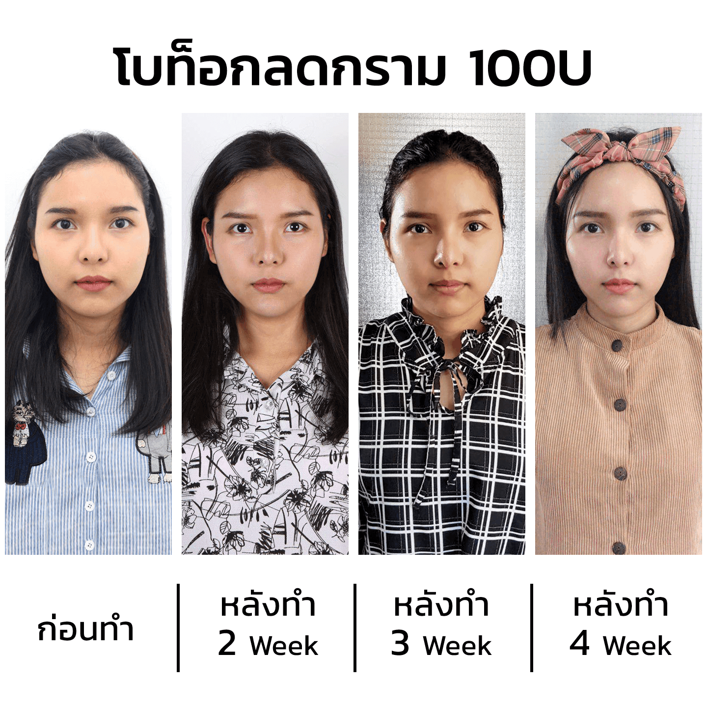 รีวิวคลินิกเสริมความงามฉีดโบท็อกลดกราม