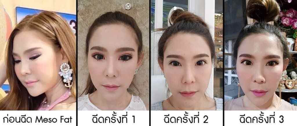 รีวิวฉีดเมโสแฟตในคลินิกเสริมความงาม