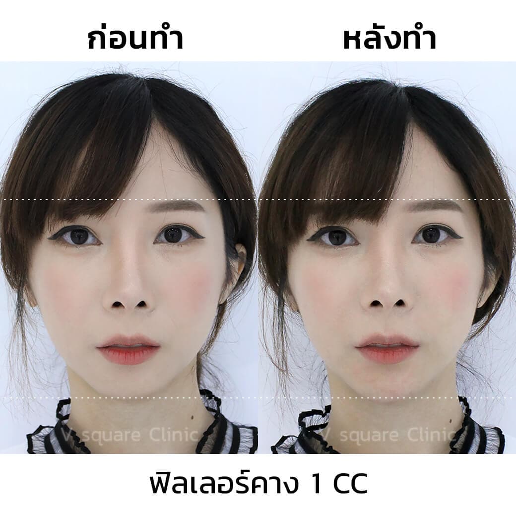 รีวิว-ฟิลเลอร์คาง-1CC