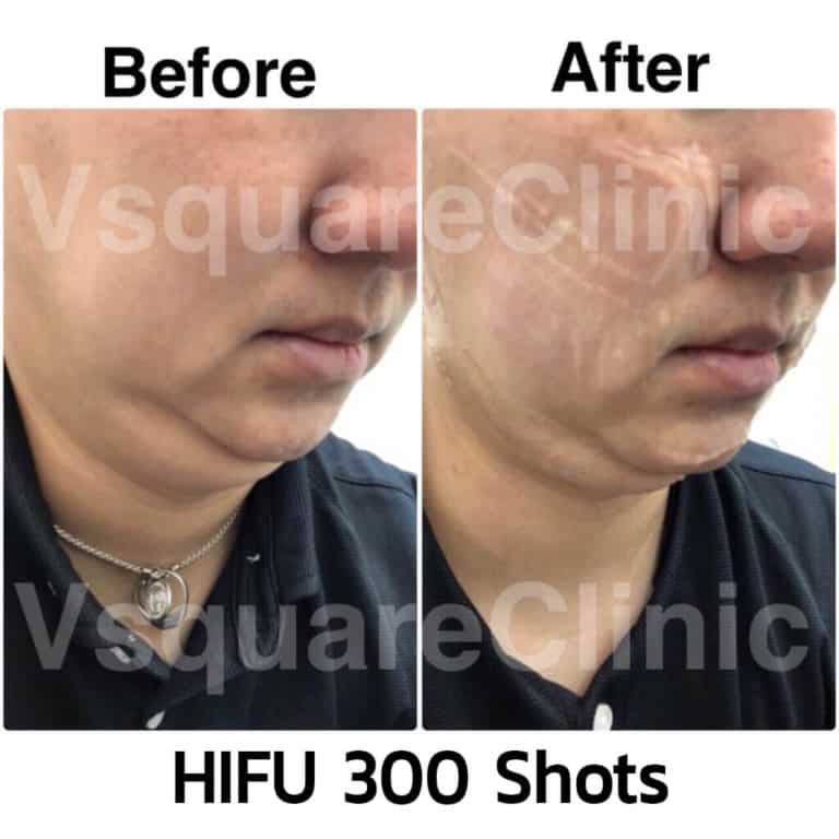 hifu-300shot-รีวิว