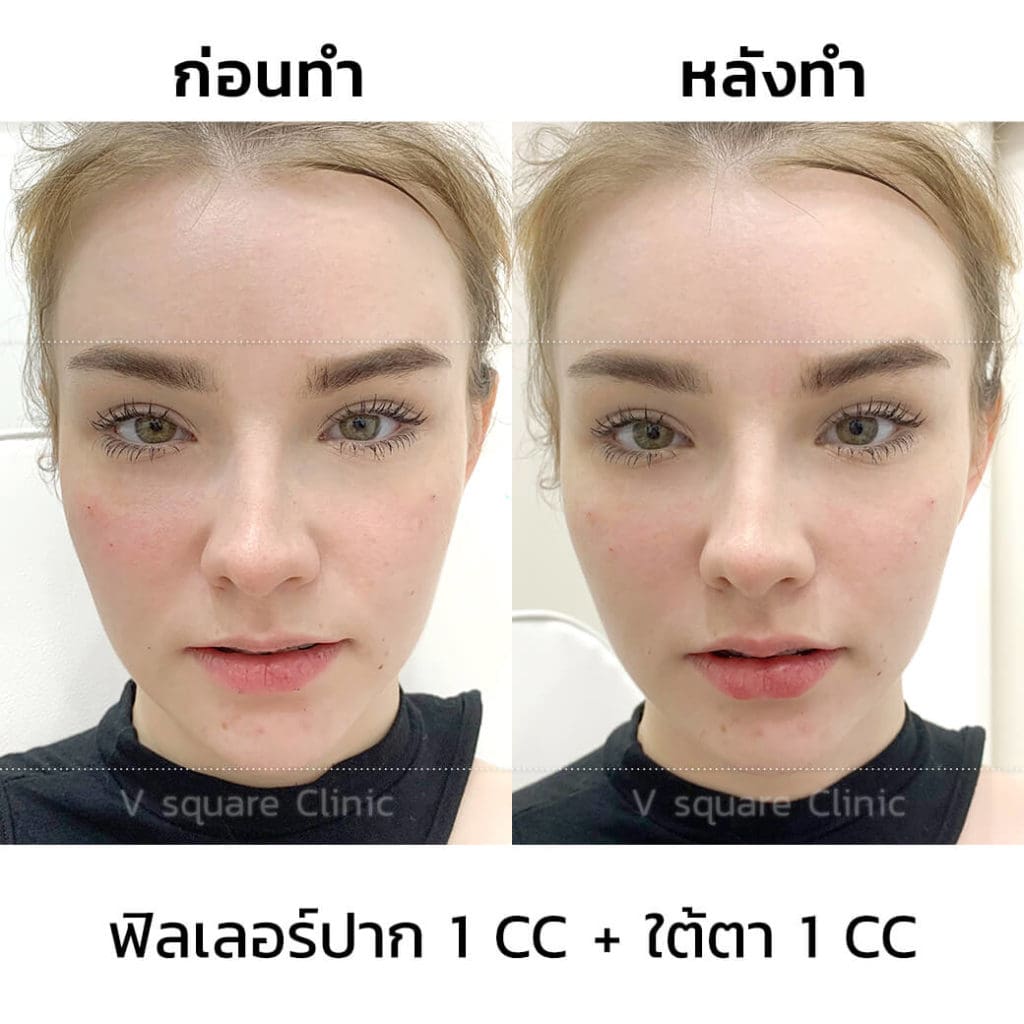 เจสซี่_ฟิลเลอร์ปาก1ccใต้ตา1cc