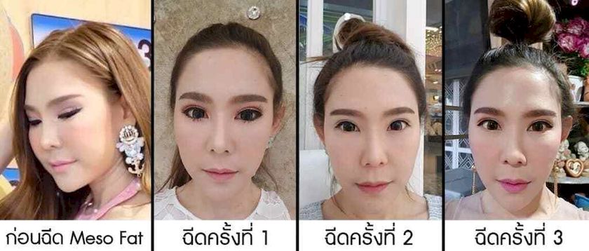 รีวิว ฉีดเมโสแตลดแก้ม